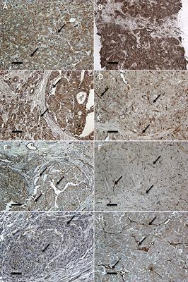 Endothelial angiopoietin-2 overexpression in explanted livers identifies subjects at higher risk of recurrence of hepatocellular carcinoma after liver transplantation